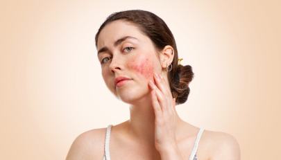 I solari giusti per chi ha la pelle con rosacea